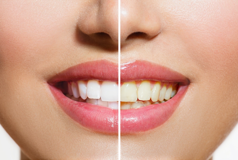 Stained Teeth | Dentist in South Ogden, UT 84403